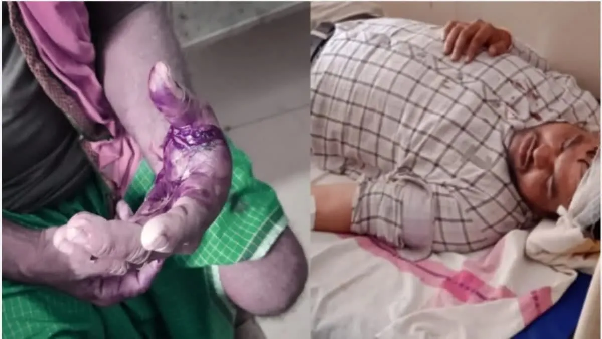 सिंगरौली में राजस्व टीम पर जानलेवा हमला, लोगों ने पटवारी को दौड़ा-दौड़ा कर पीटा