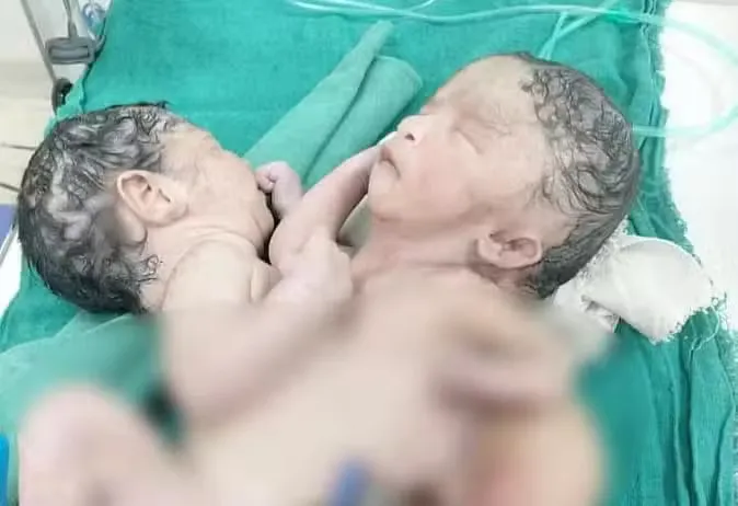 डेढ़ दिन की जिंदगी के बाद दुनिया से विदा हुए दो जिस्म एक दिल वाले नवजात