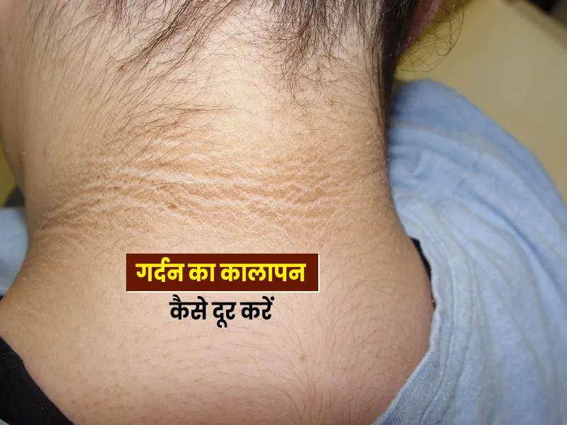 गर्दन का कालापन कैसे दूर करें? मात्र 10 दिन ये 5 आसान उपाय करके देखें, 24 घंटे में ही दिखेगा चमत्कारी असर!
