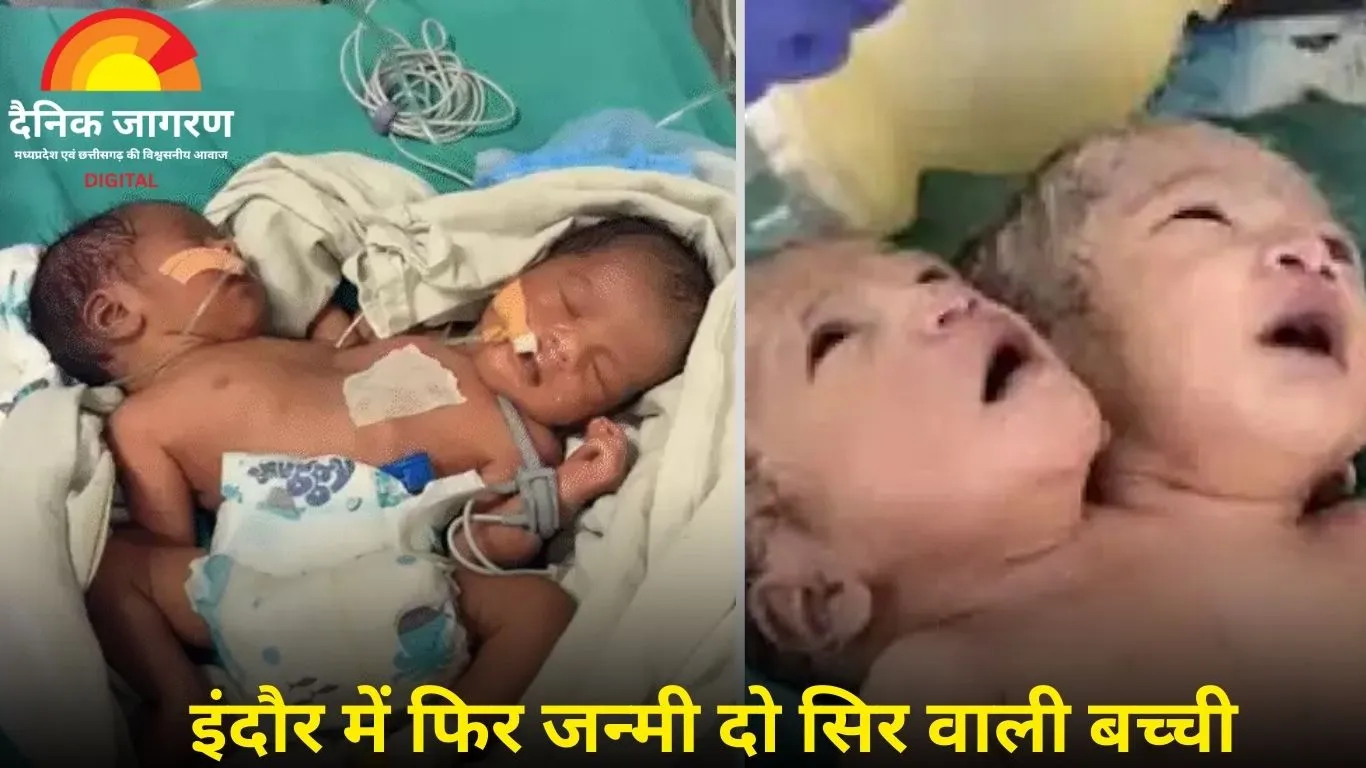 इंदौर में फिर जन्मी दो सिर वाली बच्ची, डॉक्टर बोले– अलग करने की संभावना लगभग शून्य