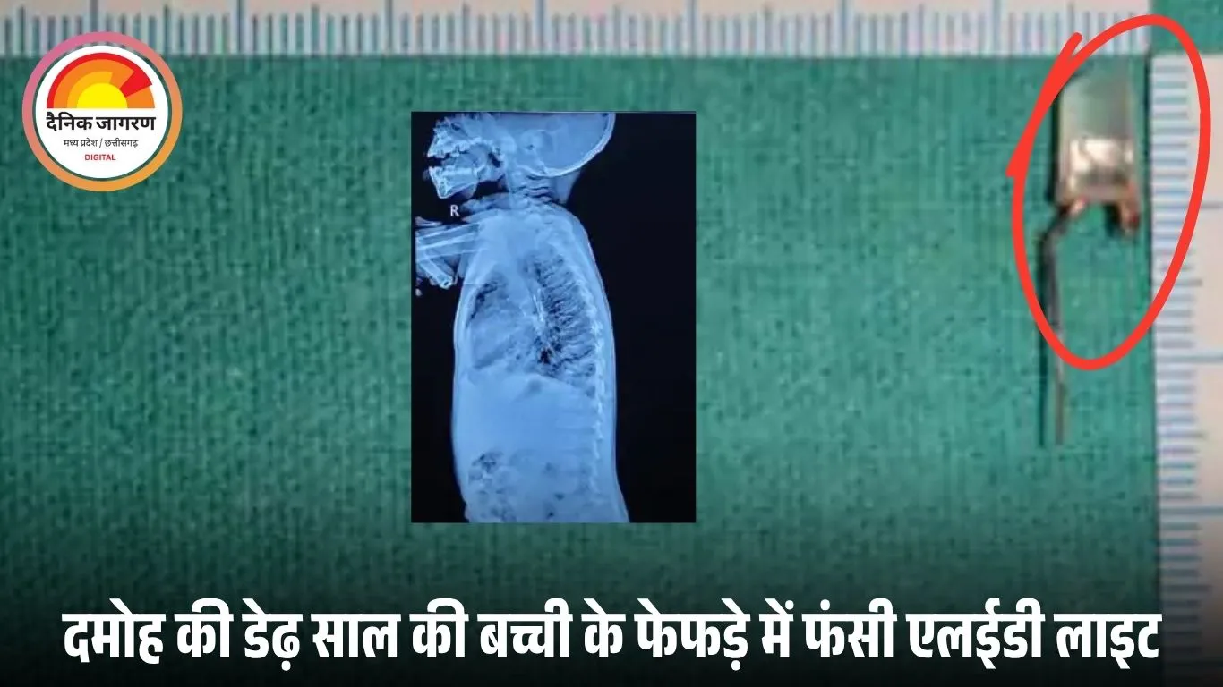 दमोह की मासूम के फेफड़े से निकली एलईडी लाइट: PICU में तीन दिन संघर्ष के बाद बची बच्ची की जान