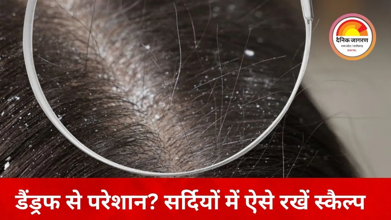 ठंड में बढ़ती डैंड्रफ की समस्या: सर्दियों में रूखी स्कैल्प बन रही वजह, डॉक्टरों ने बताए बचाव के उपाय