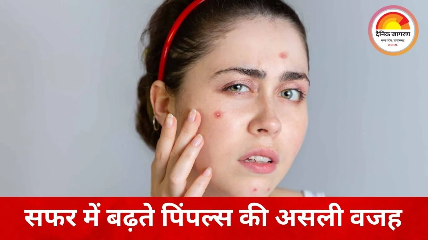 सफर में क्यों बढ़ जाते हैं पिंपल्स? ट्रैवल के दौरान एक्ने बढ़ने की वजहें और बचाव के कारगर तरीके