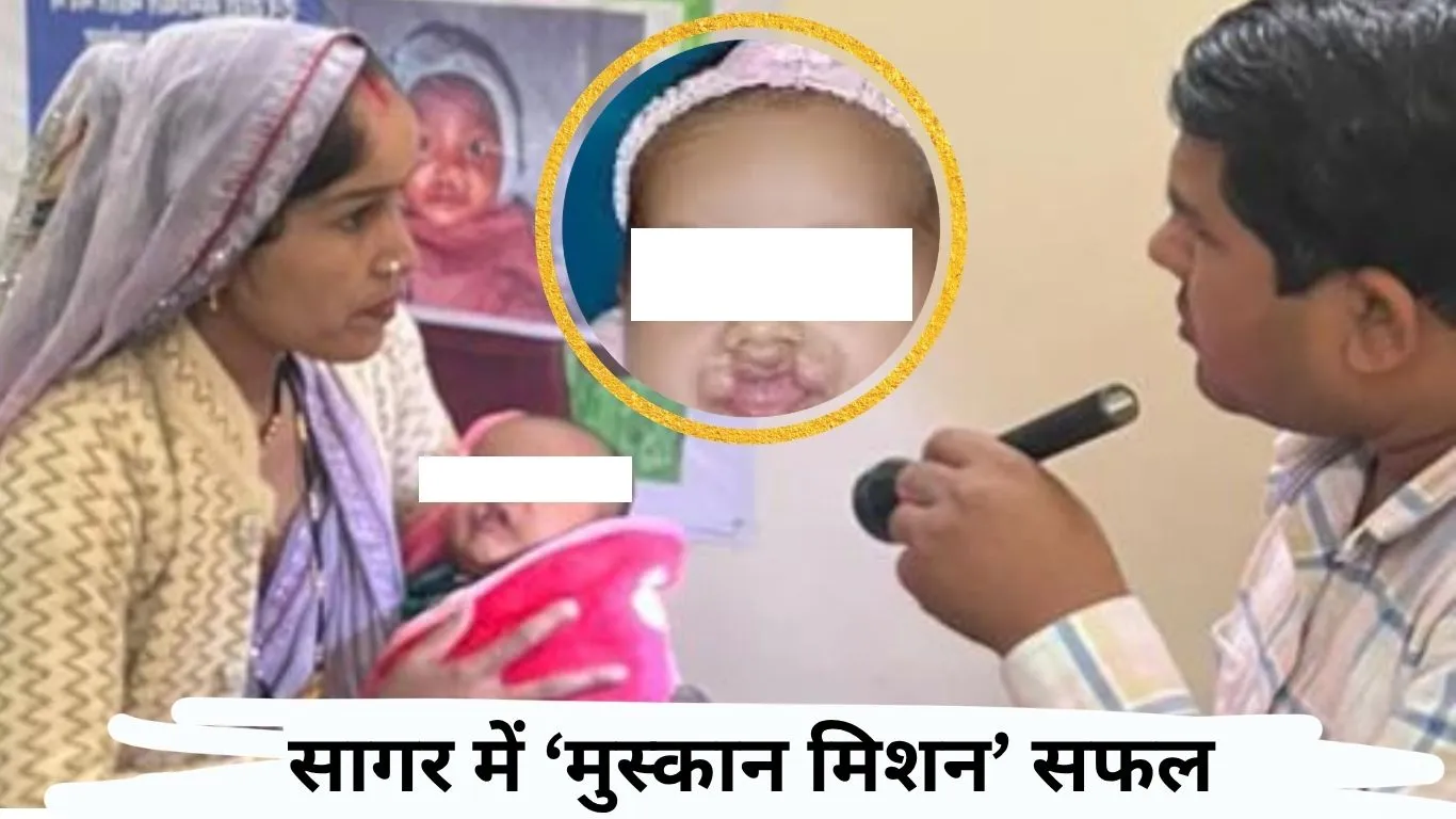 सागर में ‘मुस्कान मिशन’: कटे होंठ-तालू से जूझ रहे बच्चों को मिल रही नई जिंदगी