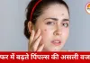 सफर में क्यों बढ़ जाते हैं पिंपल्स? ट्रैवल के दौरान एक्ने बढ़ने की वजहें और बचाव के कारगर तरीके