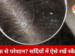ठंड में बढ़ती डैंड्रफ की समस्या: सर्दियों में रूखी स्कैल्प बन रही वजह, डॉक्टरों ने बताए बचाव के उपाय