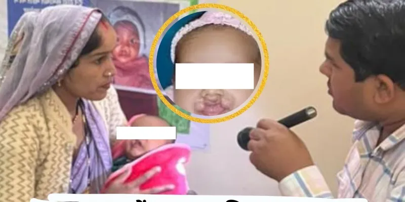 सागर में ‘मुस्कान मिशन’: कटे होंठ-तालू से जूझ रहे बच्चों को मिल रही नई जिंदगी