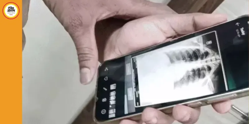 डॉक्टर परेशान, मरीज हैरान: रीवा में एक्स-रे व्यवस्था ठप